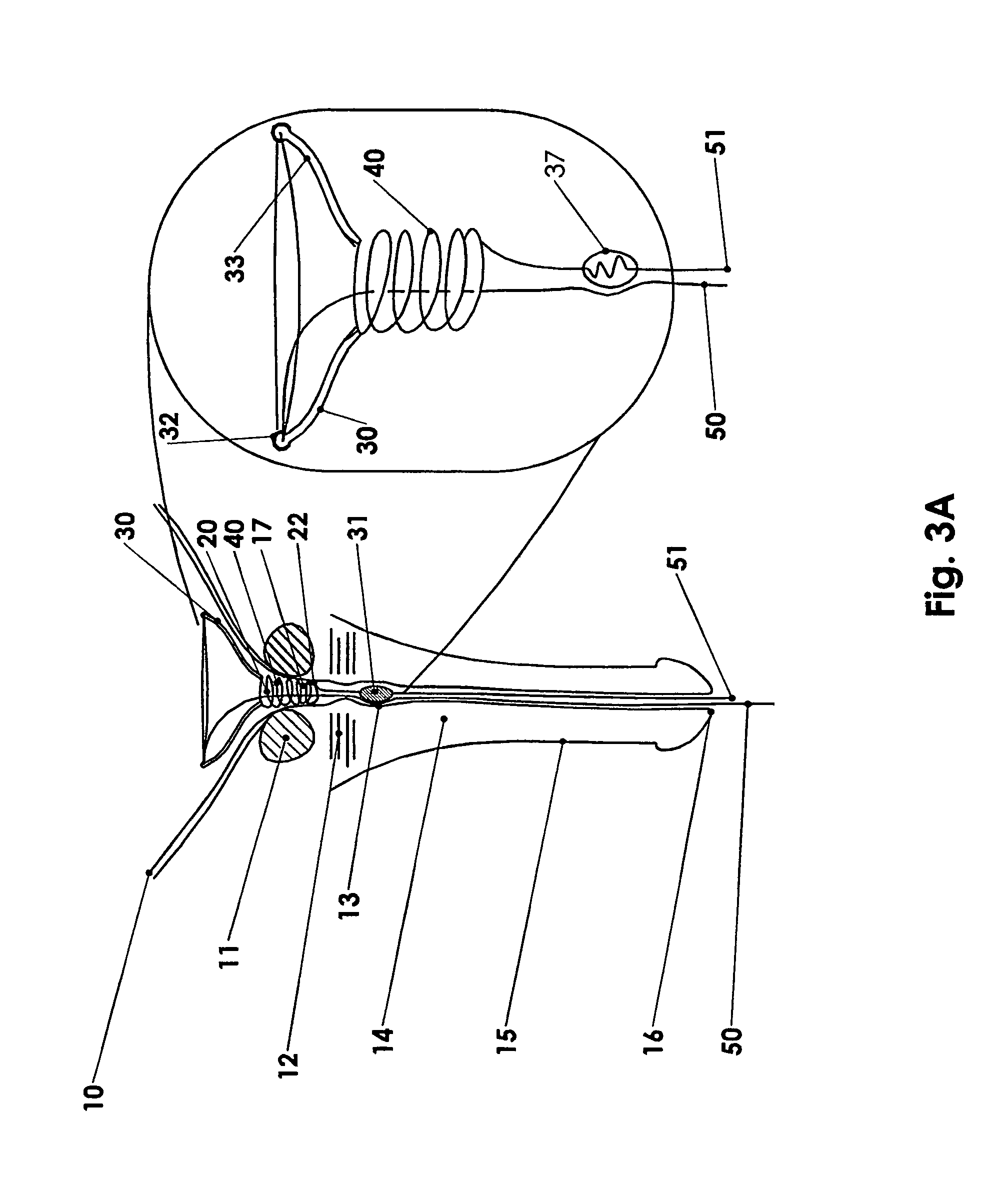 Temporary prostatic stent for benign prostatic hyperplasia