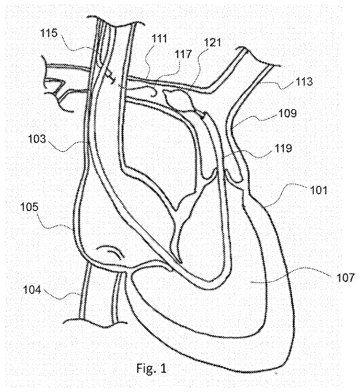 Pulmonary arterial compliance enhancement and control device