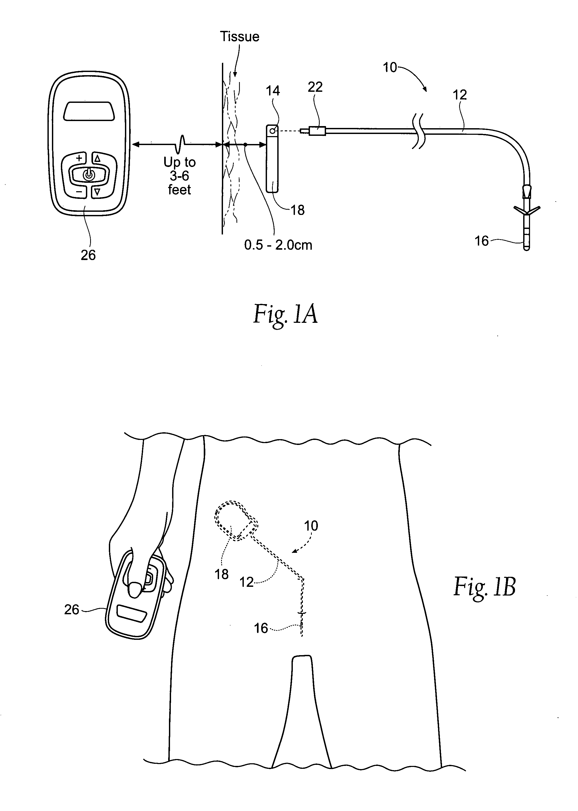 Systems and methods for bilateral stimulation of left and right branches of the dorsal genital nerves to treat urologic dysfunctions