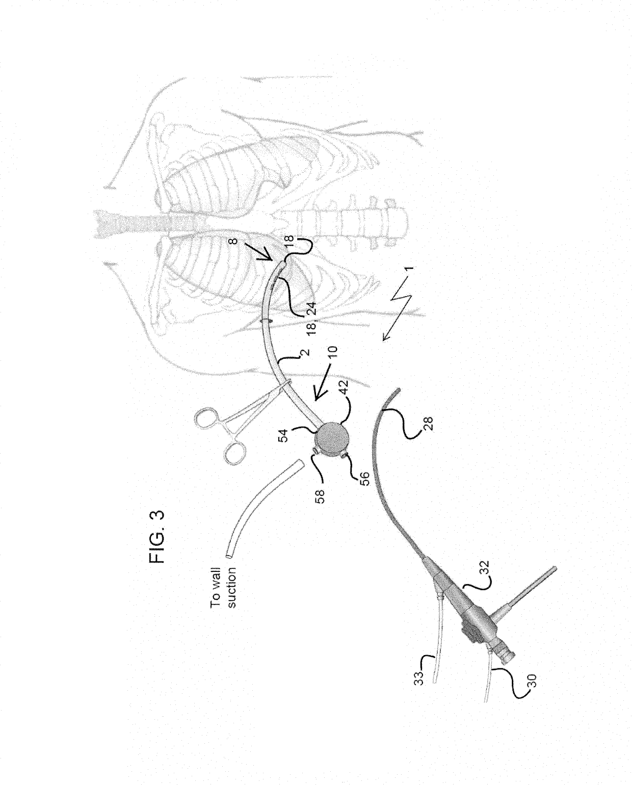 Thoracic catheter device