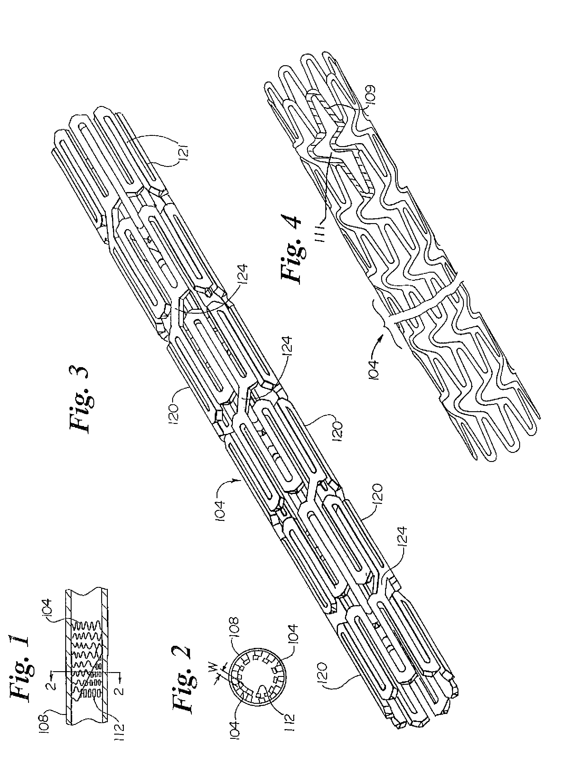 Stent for In-Stent Restenosis