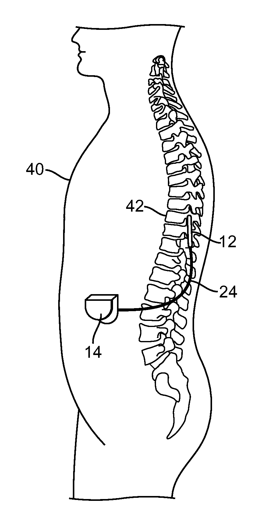 Spatially selective nerve stimulation in high-frequency nerve conduction block and recruitment