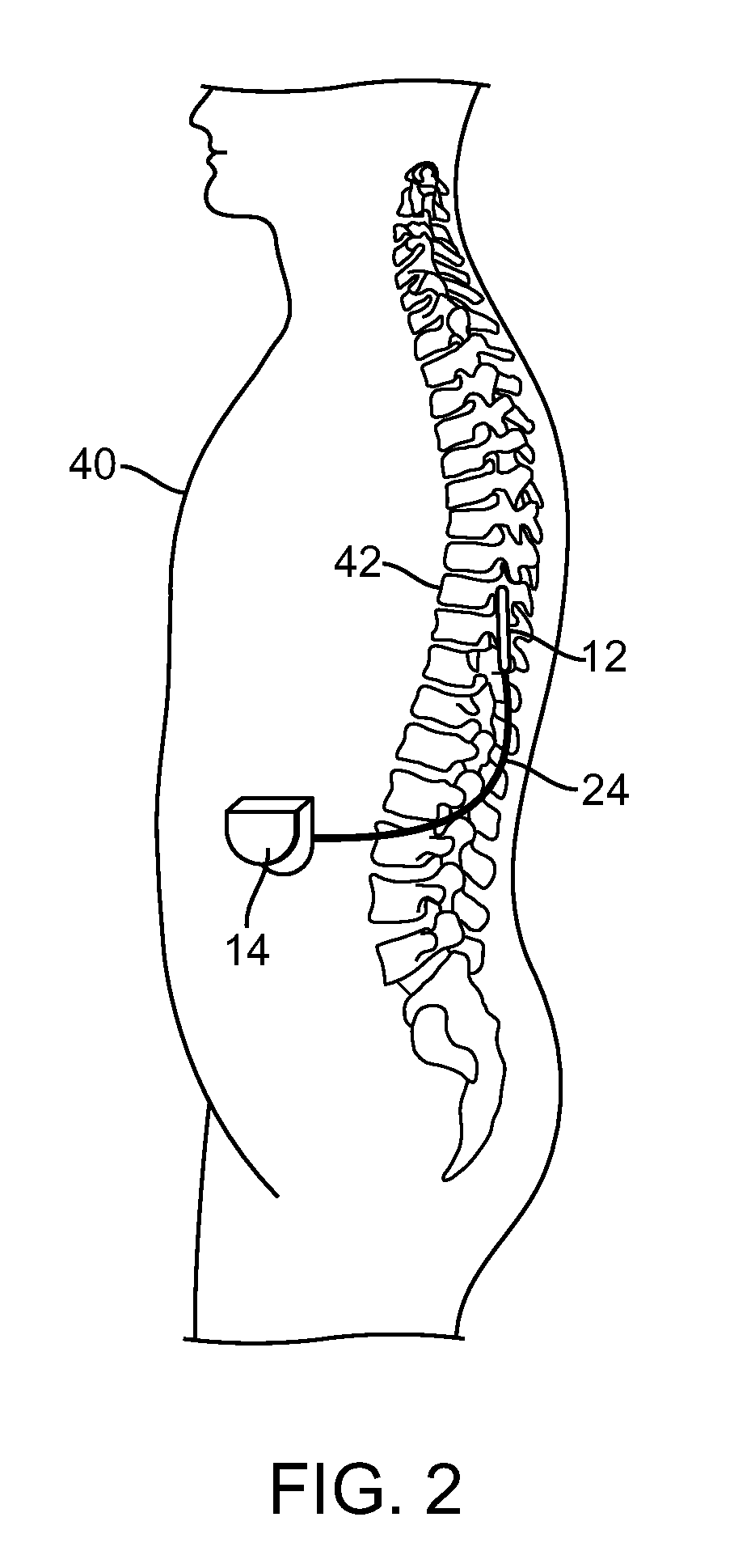 Spatially selective nerve stimulation in high-frequency nerve conduction block and recruitment