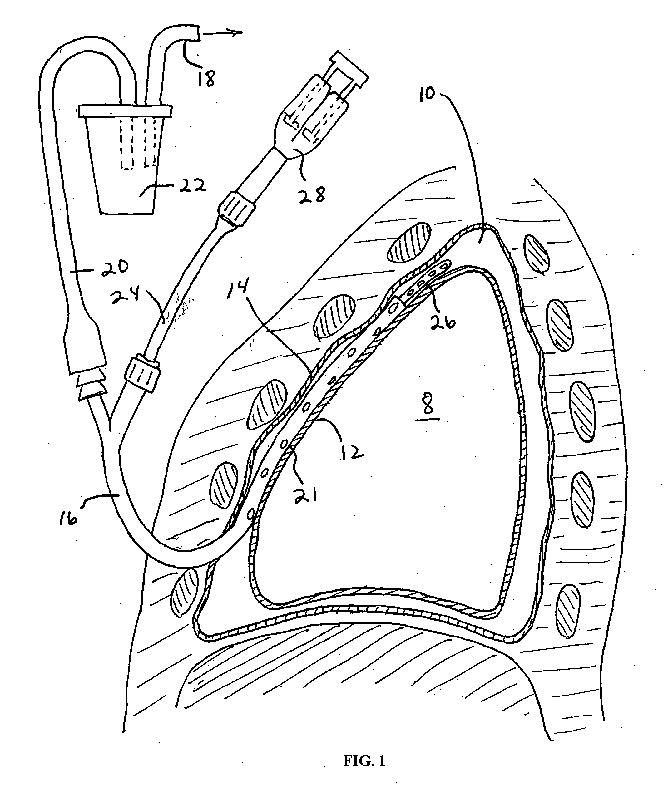 Pleural effusion treatment device, method and material