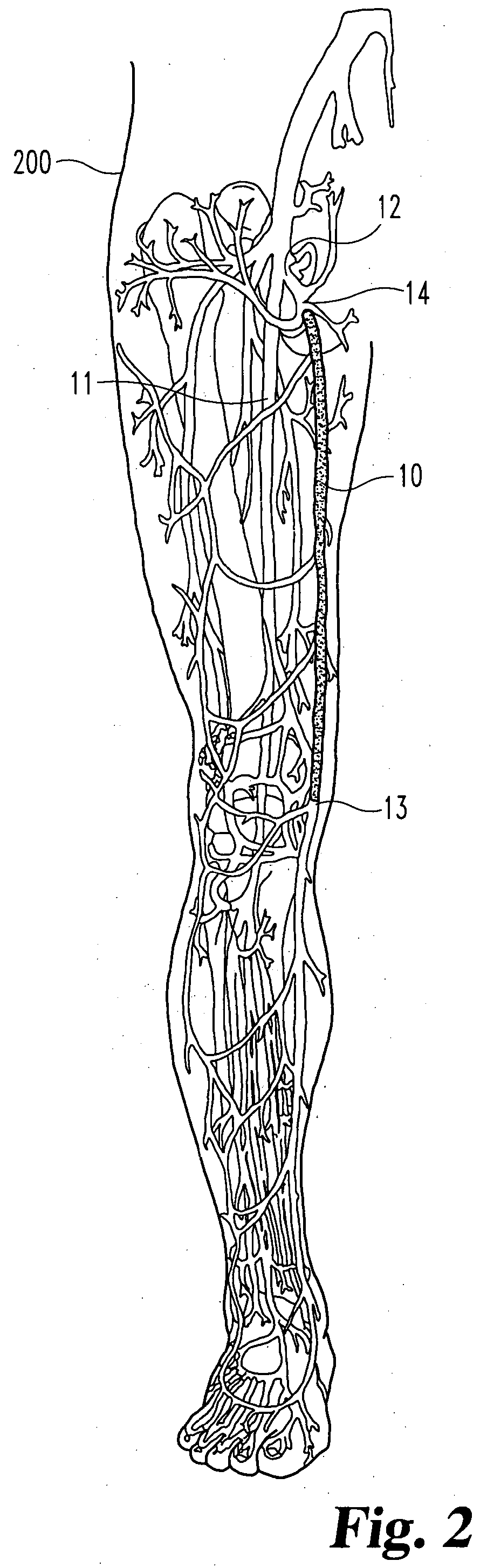 Inflatable occlusion devices, methods, and systems