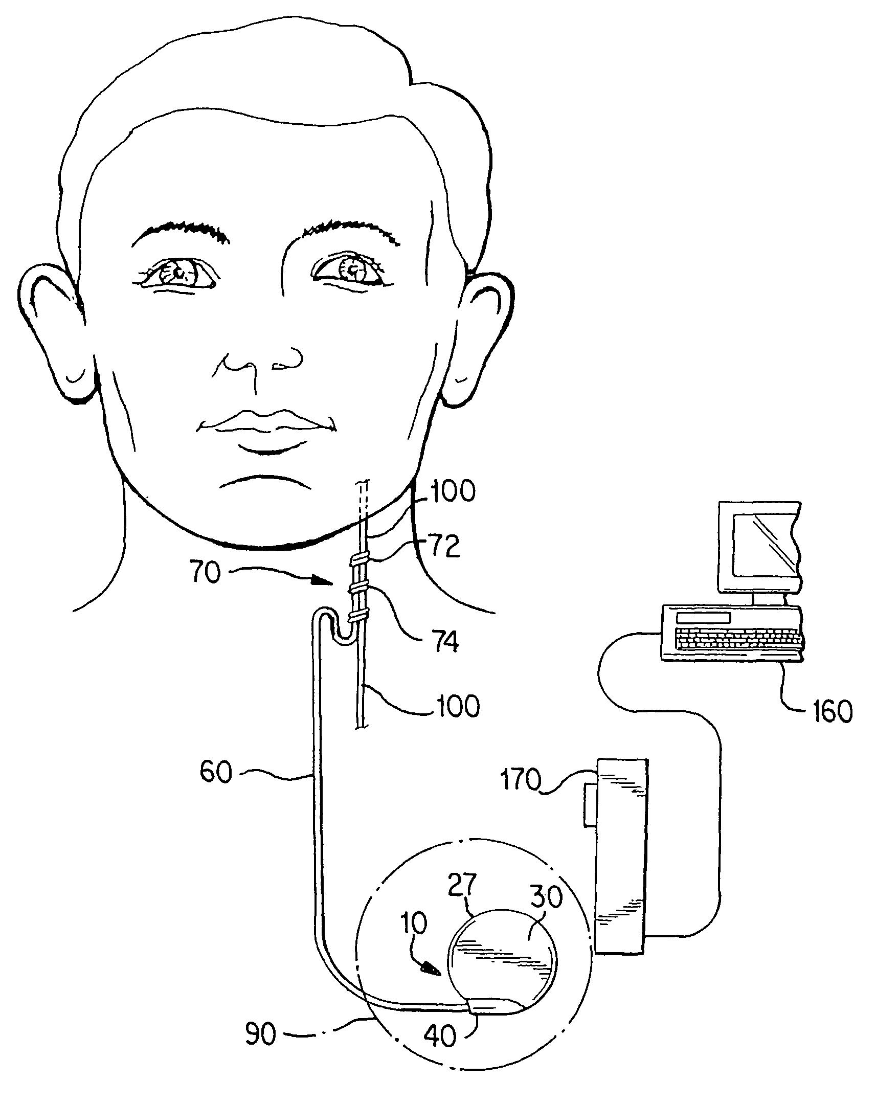 Cranial nerve stimulation to treat a vocal cord disorder