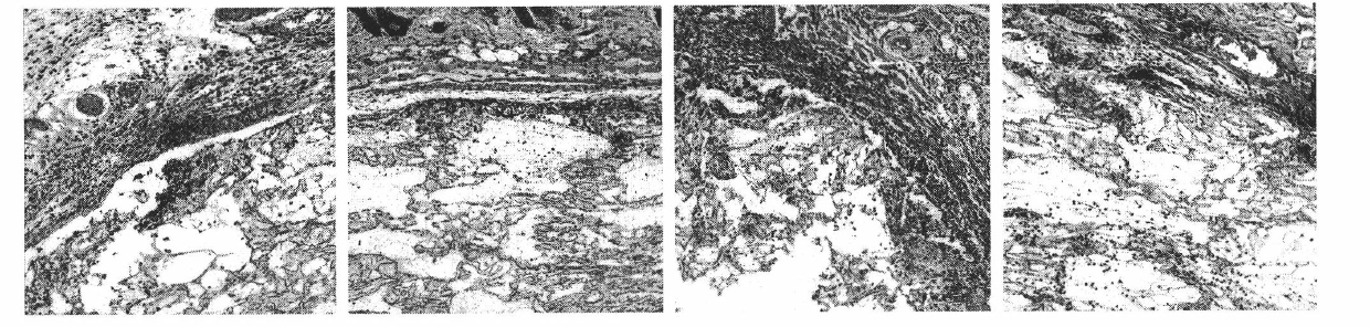 Preparation consisting of PLGA (Polylactic Acid-Polyglycolic Acid)/TCP (Tris Calcium Polymer) and MSC (Mesenchymal Stem Cells) of compound MSC and application thereof