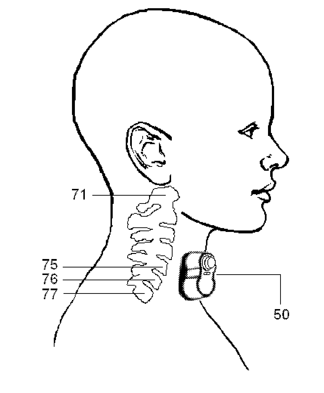 Non-invasive vagus nerve stimulation devices and methods to treat or avert atrial fibrillation