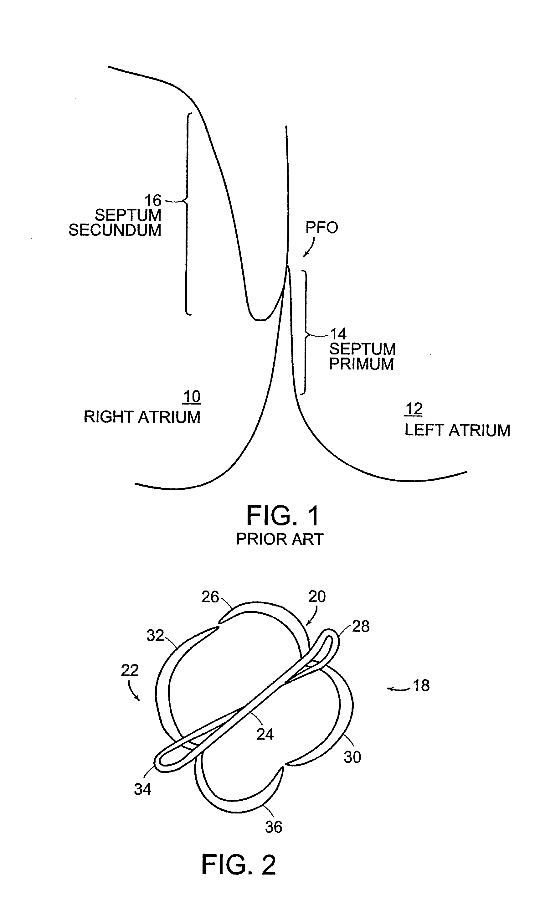 Patent foramen ovale (PFO) closure method and device