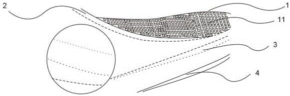 Eye patch applied to juvenile glaucoma