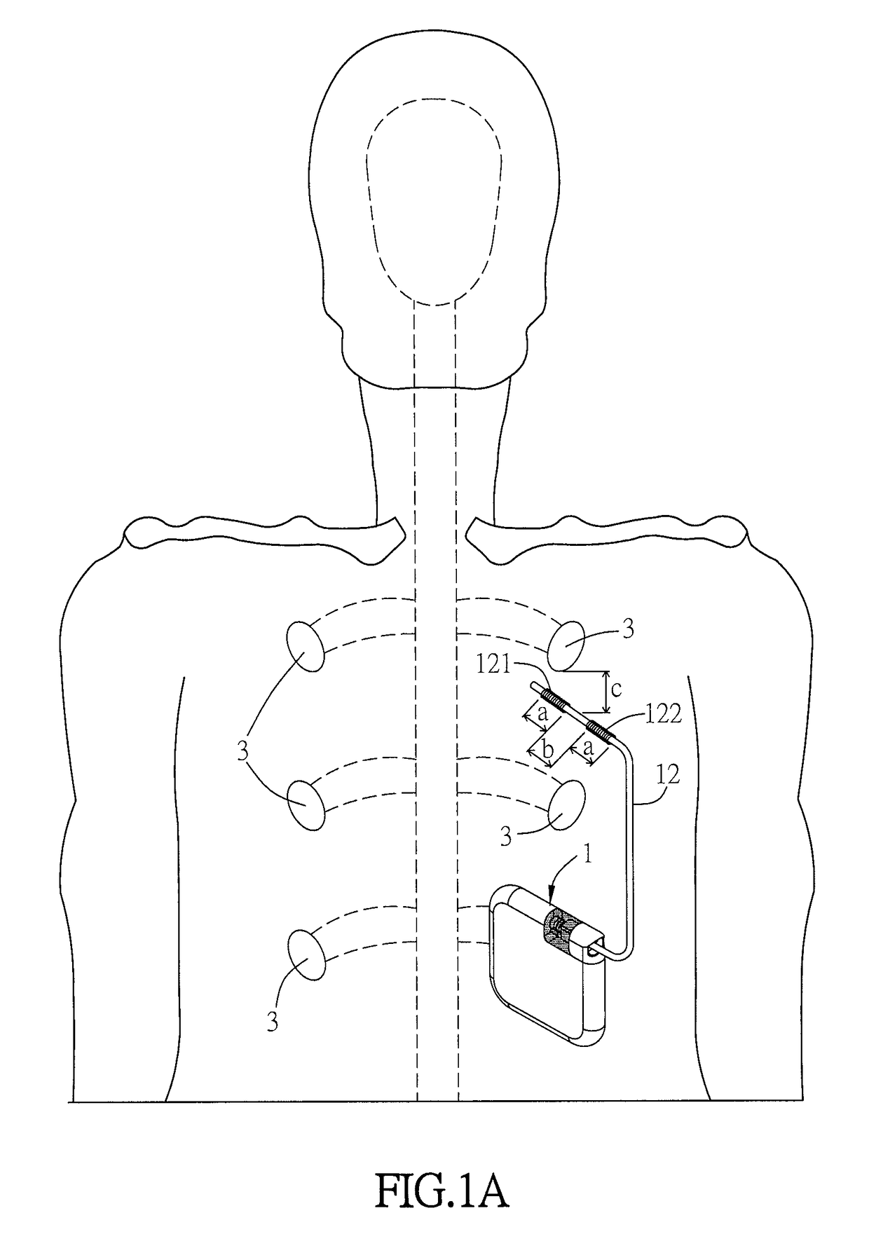 Method of reducing renal hypertension and computer-readable medium