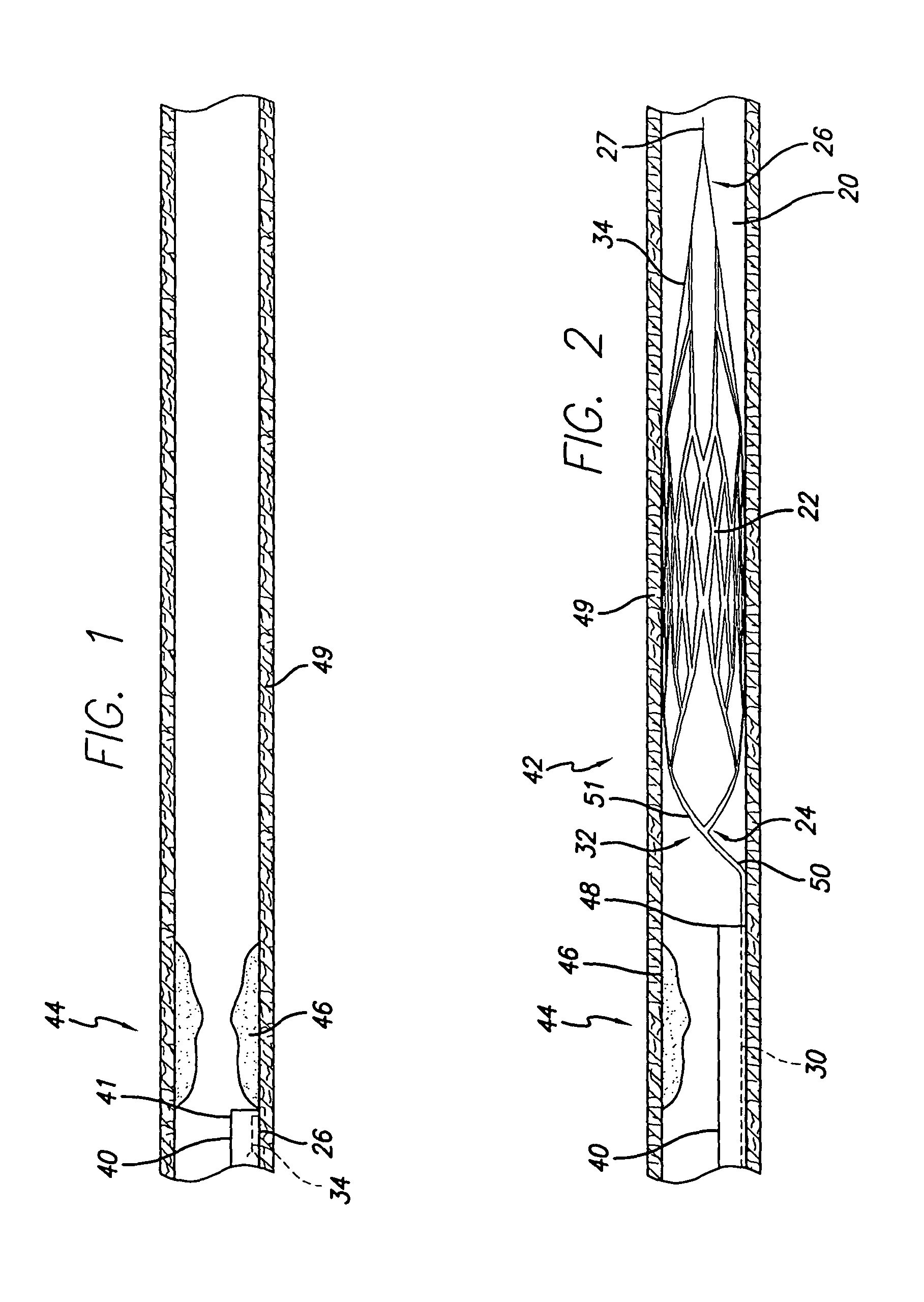 Intravascular device and system