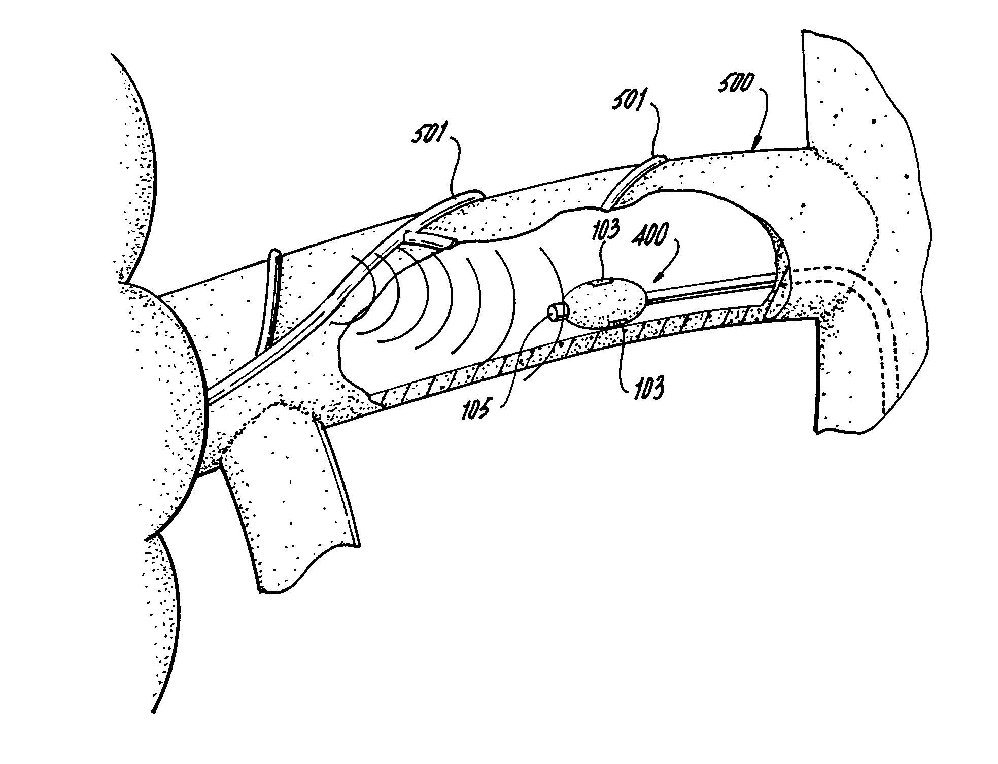 Renal denervation system