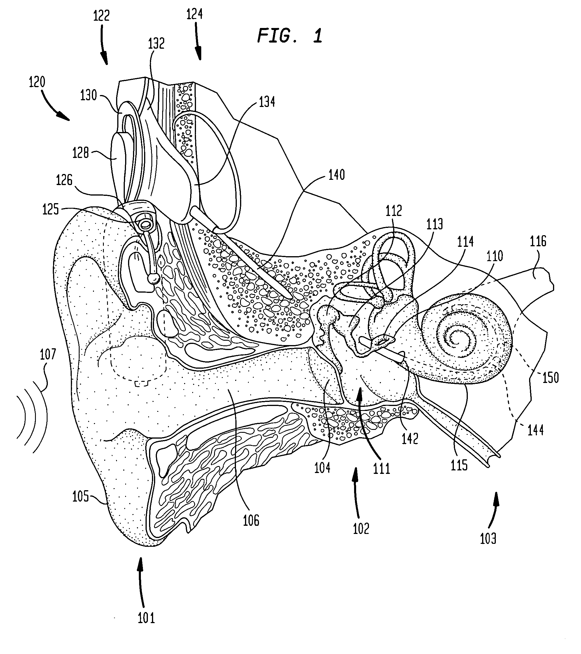 Prosthetic hearing implant electrode assembly having optimal length for atraumatic implantation