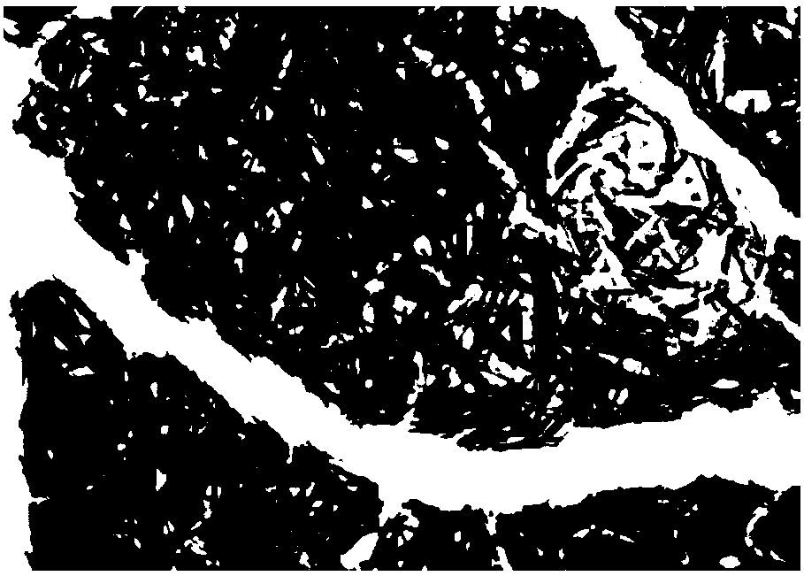 Urine protein marker for chronic pancreatitis and application thereof