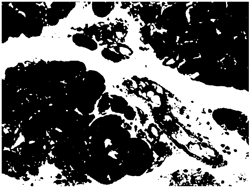 Urine protein marker for chronic pancreatitis and application thereof