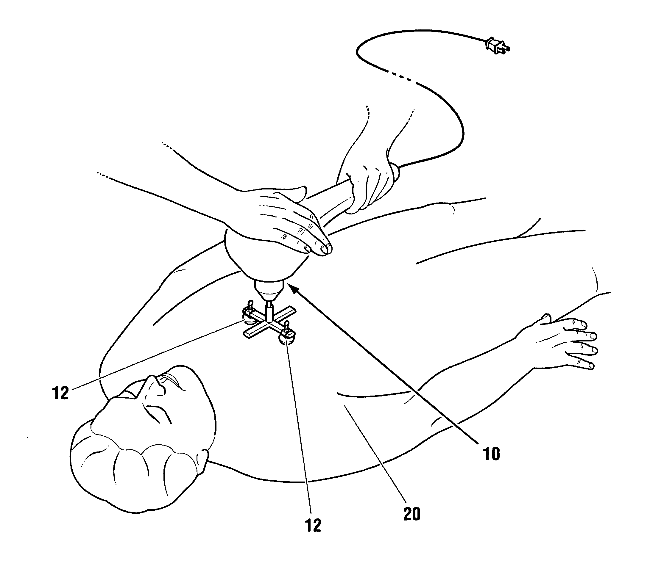 Vibration method for clearing acute arterial thrombotic occlusions in the emergency treatment of heart attack and stroke