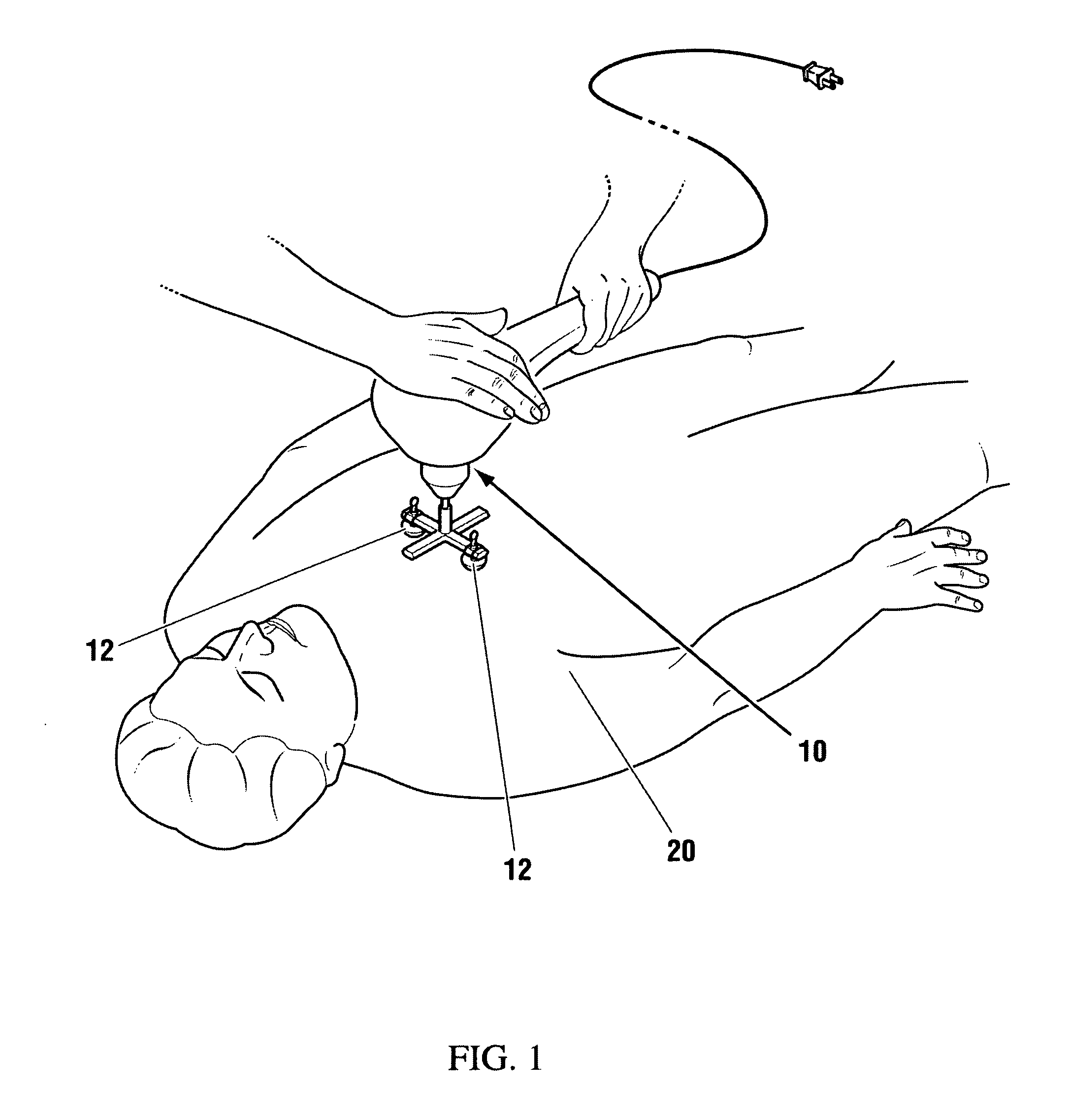 Vibration method for clearing acute arterial thrombotic occlusions in the emergency treatment of heart attack and stroke