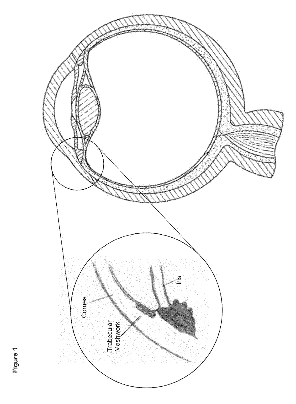 Devices and methods for treatment of ocular disorders through delivery of therapeutic nucleic acids