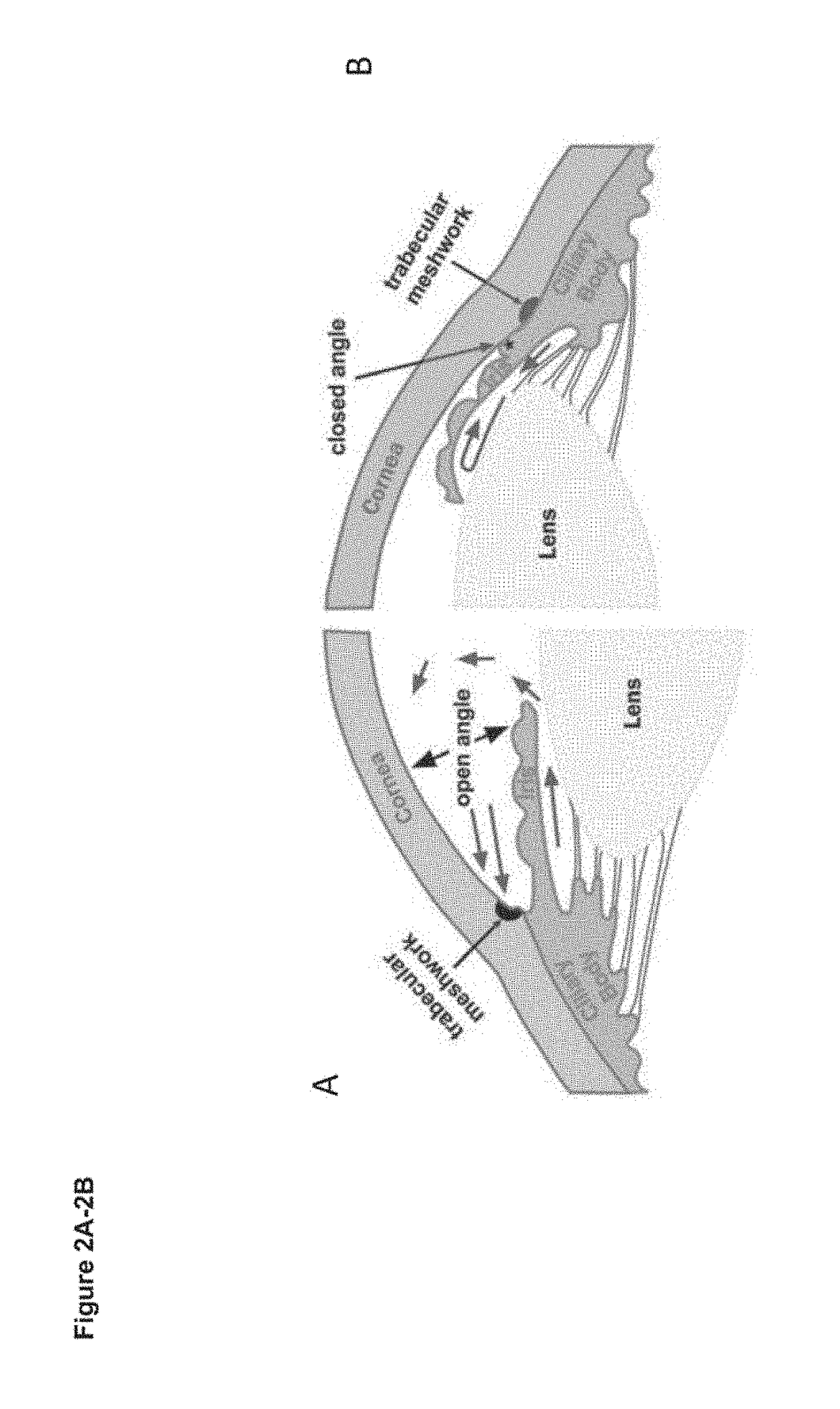 Devices and methods for treatment of ocular disorders through delivery of therapeutic nucleic acids