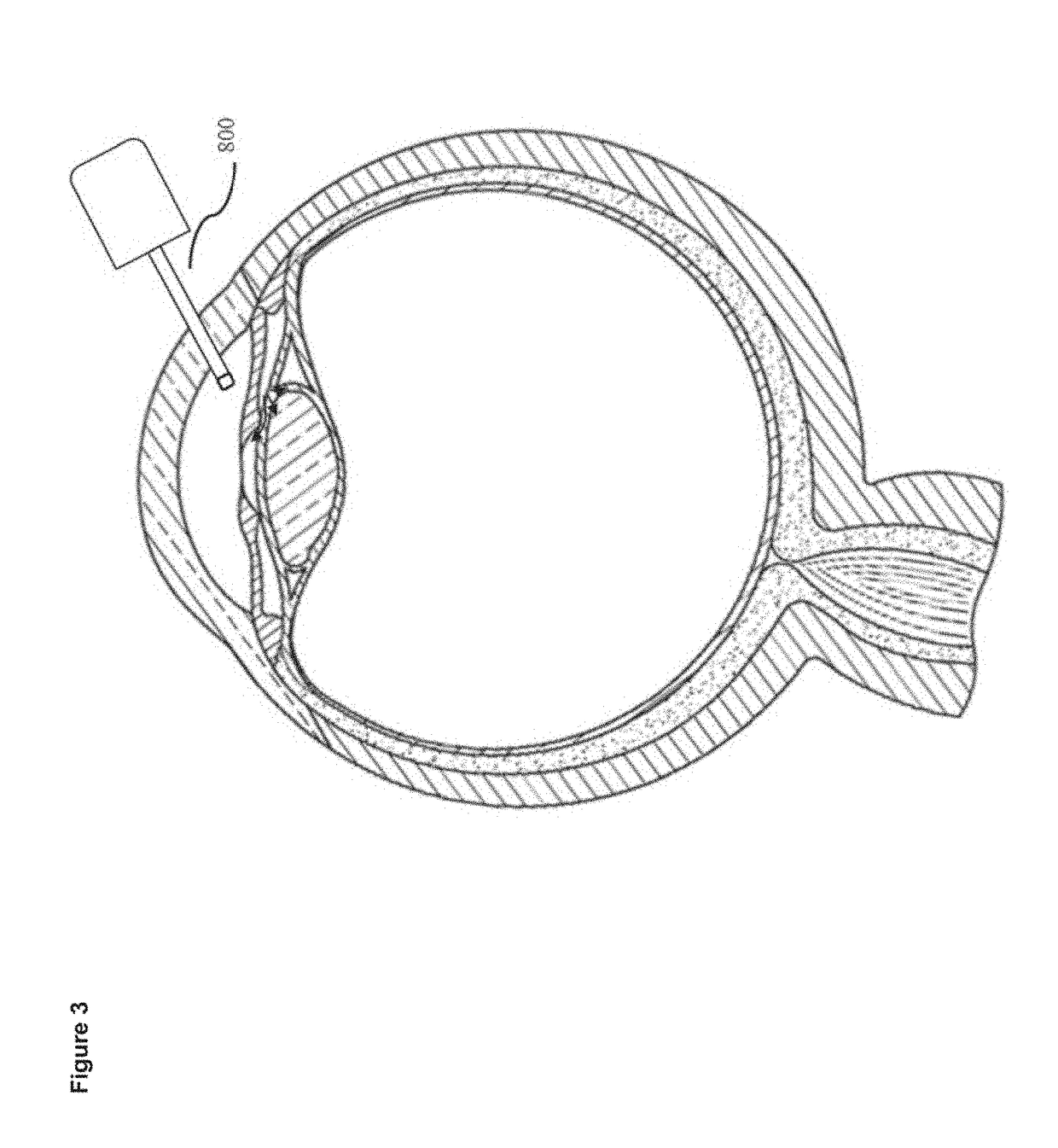 Devices and methods for treatment of ocular disorders through delivery of therapeutic nucleic acids