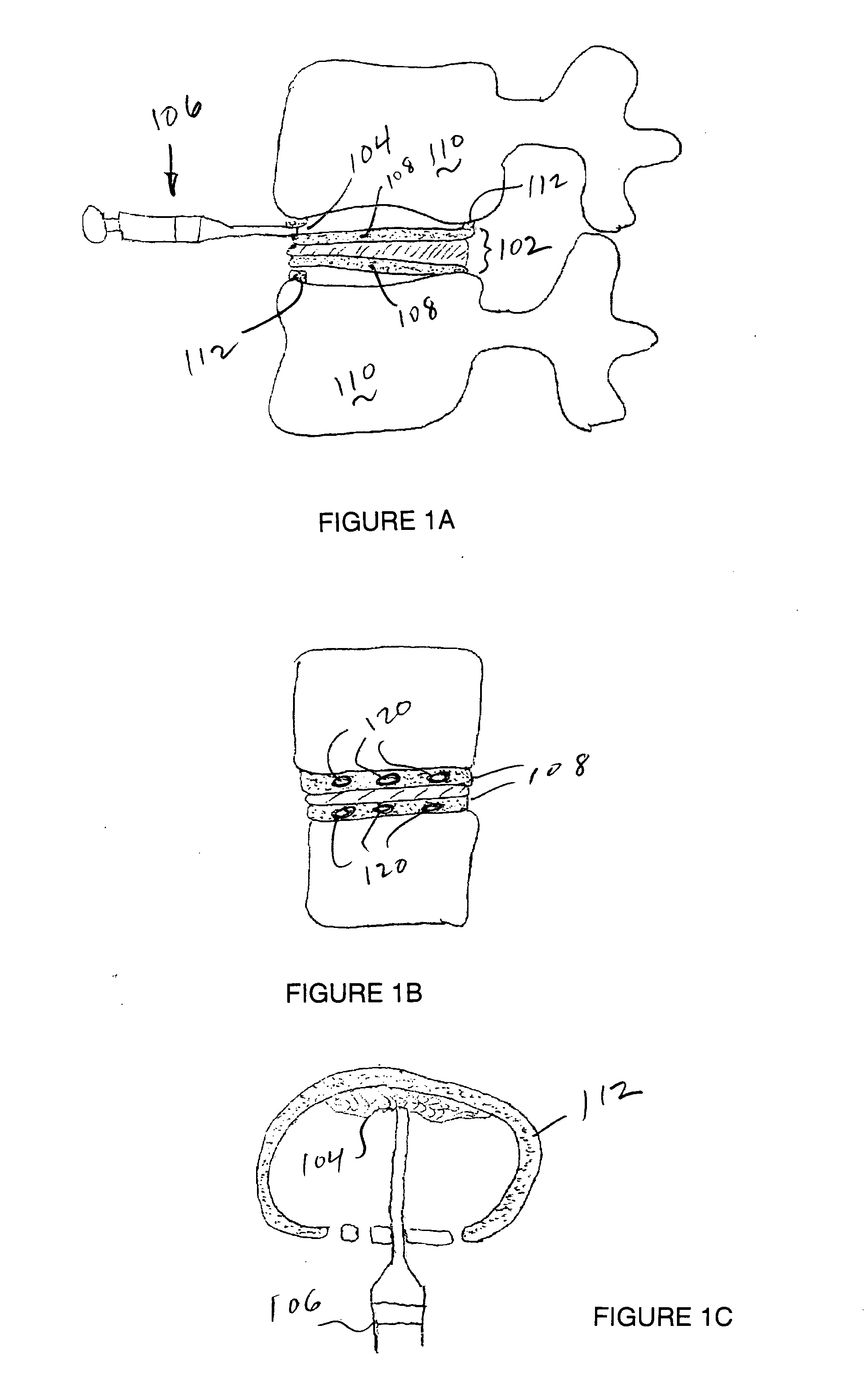 Cemented artificial disc replacements