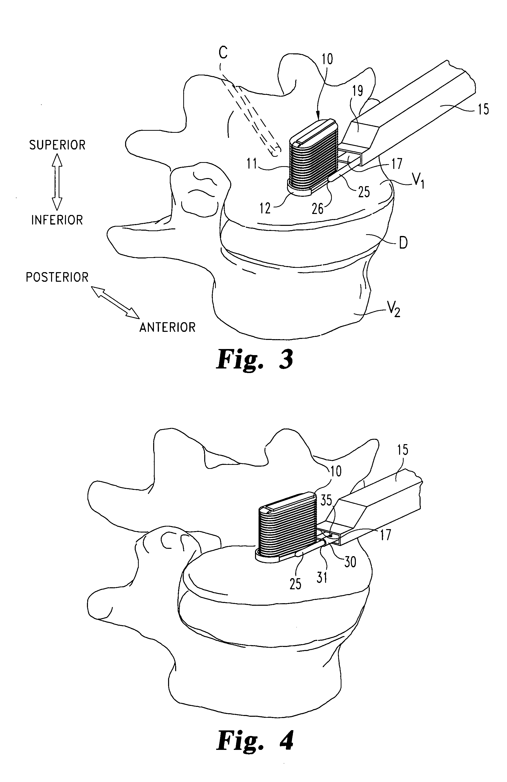 Apparatus and method for injecting fluent material at a distracted tissue site