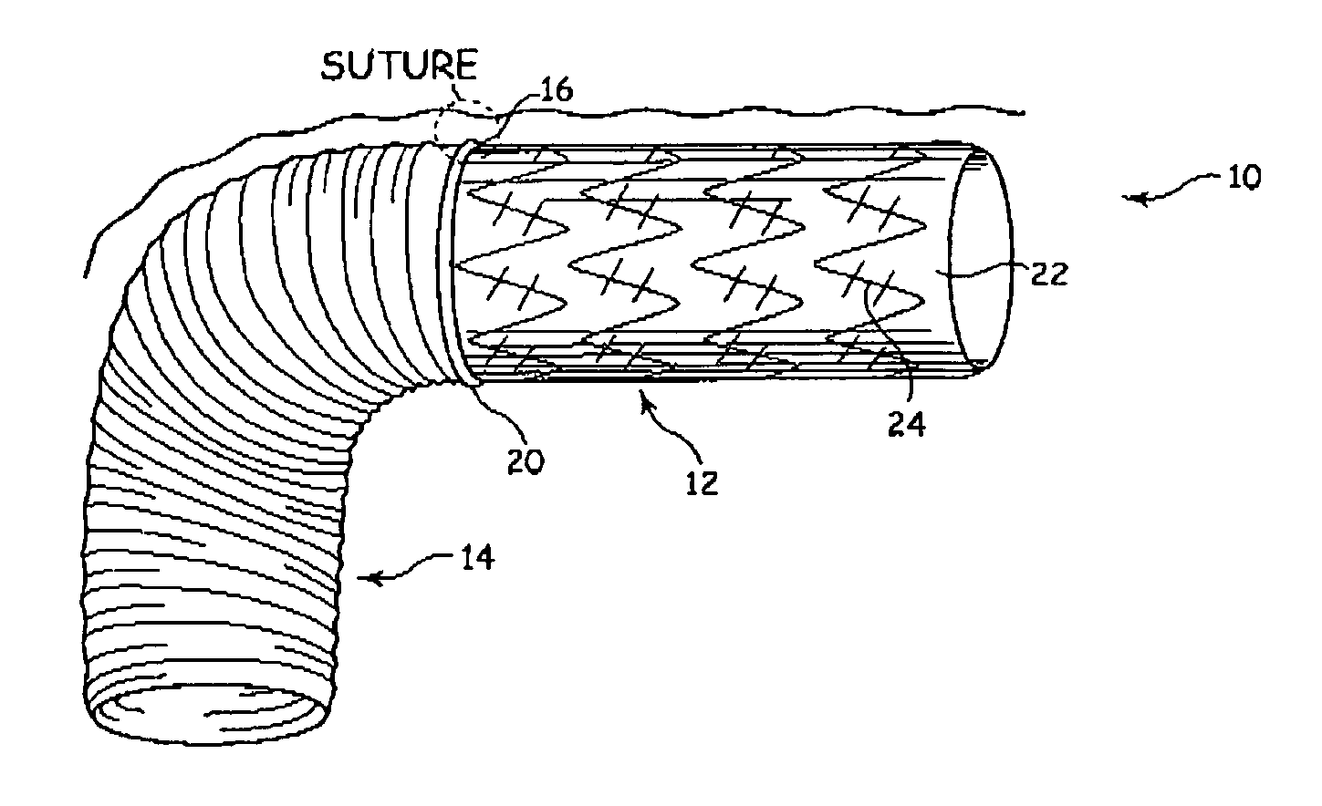 Aortic graft device