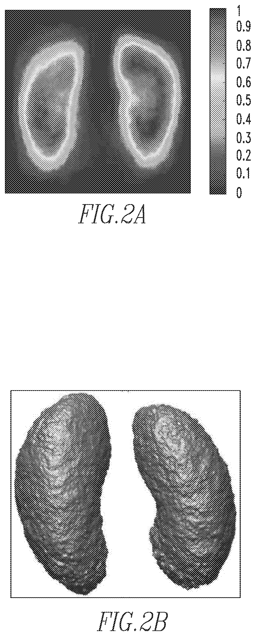 Automated segmentation of organs, such as kidneys, from magnetic resonance images