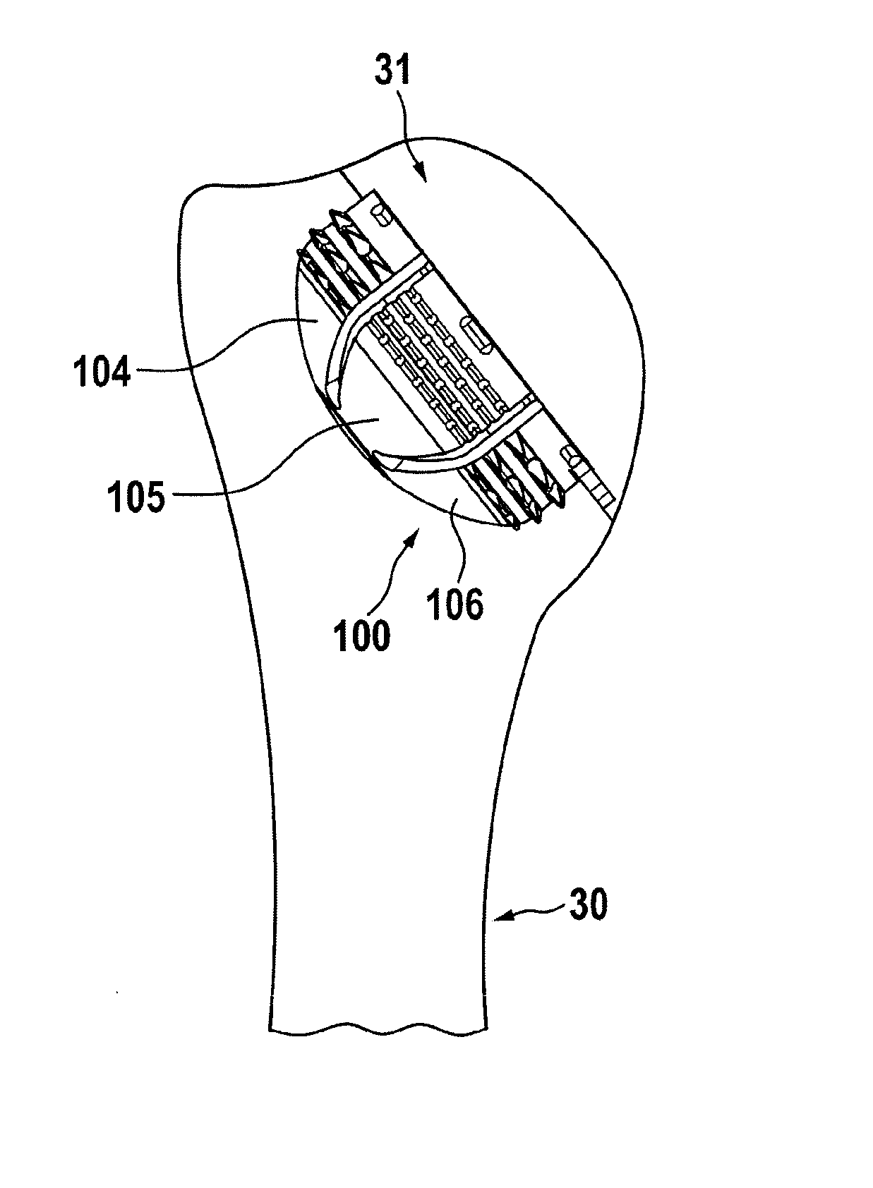 Stemless shoulder implant