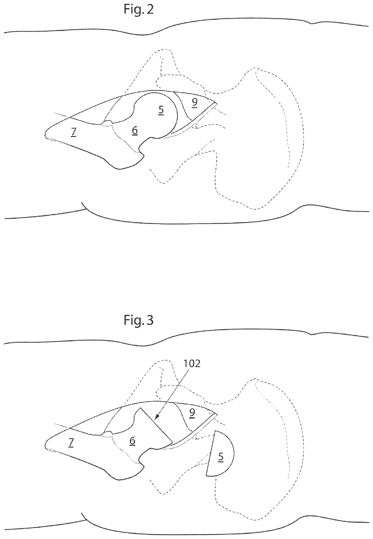 Hip joint device and method