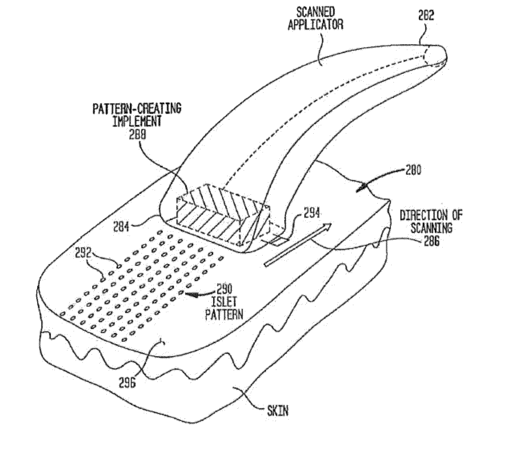 Methods and devices for inflammation treatment