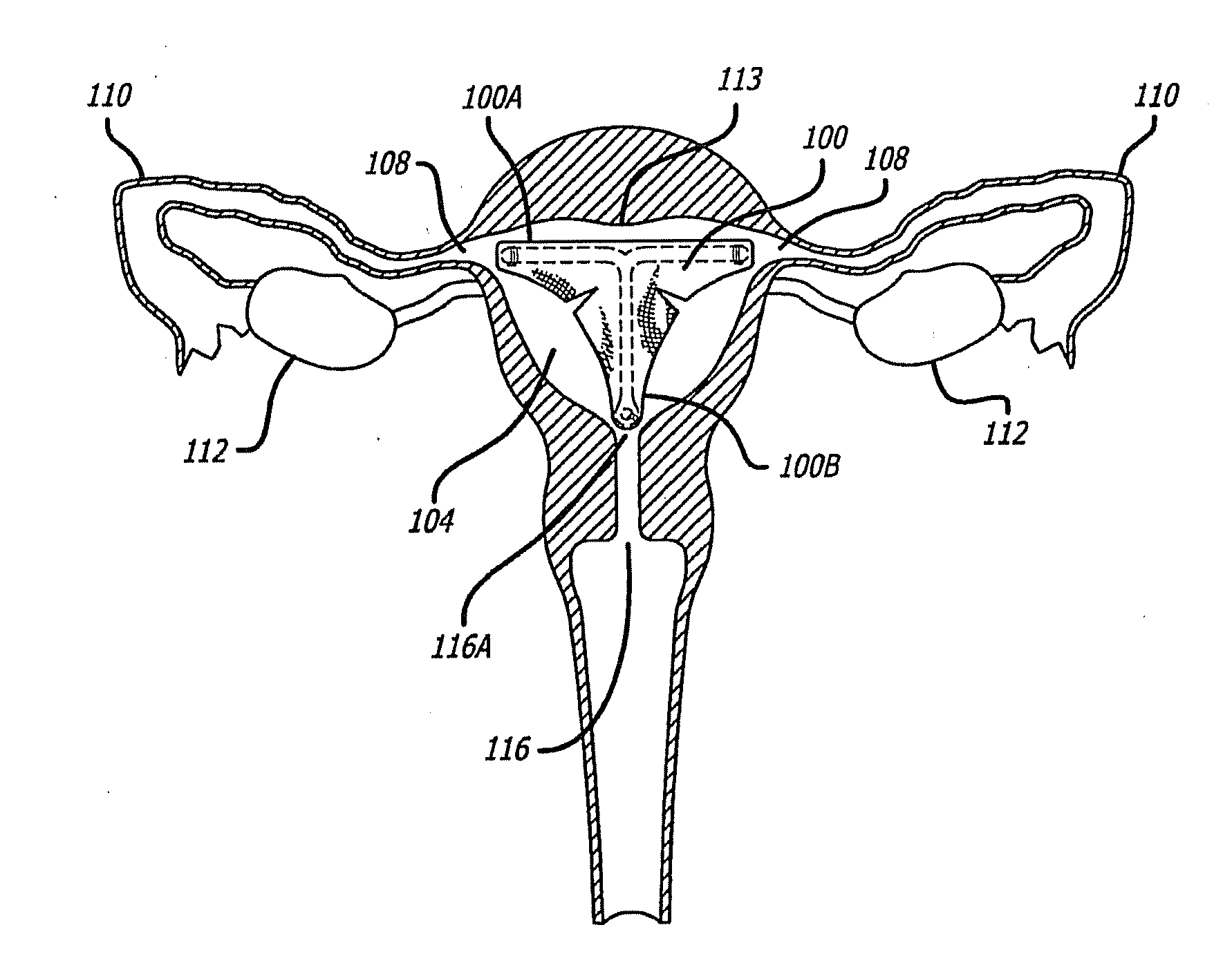 Method and apparatus for creating intrauterine adhesions