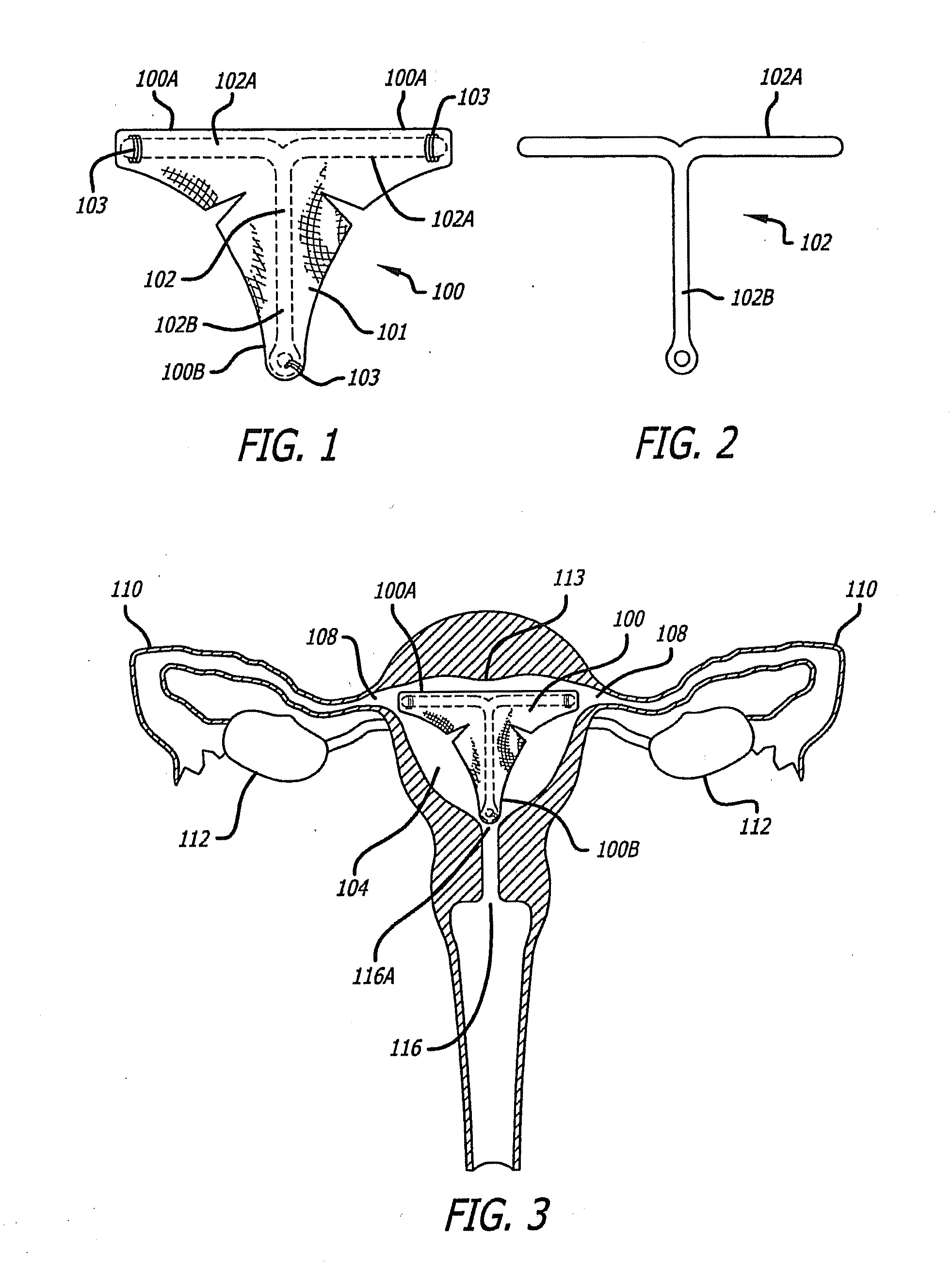 Method and apparatus for creating intrauterine adhesions