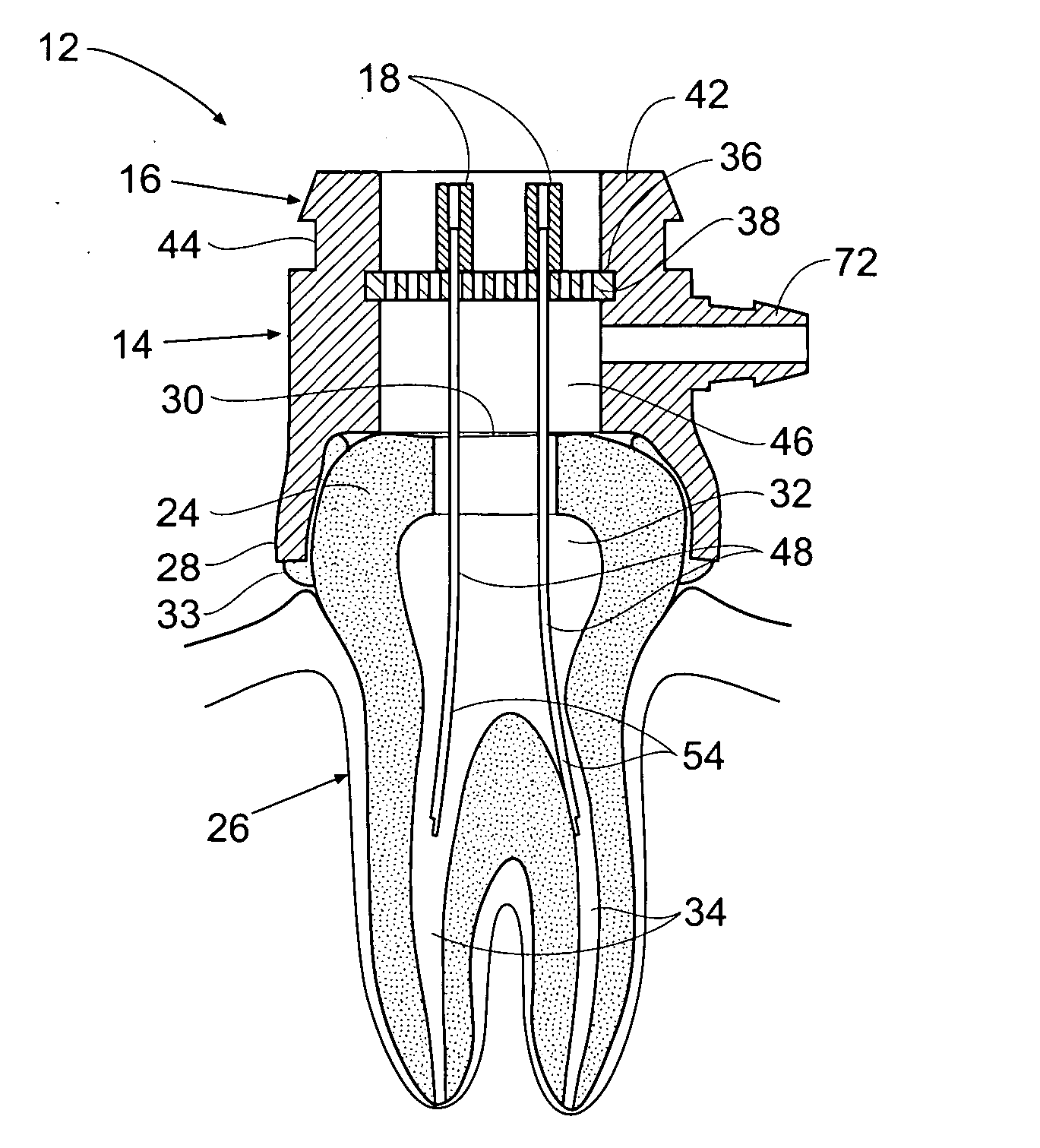 Apparatus and methods for treating tooth root canals