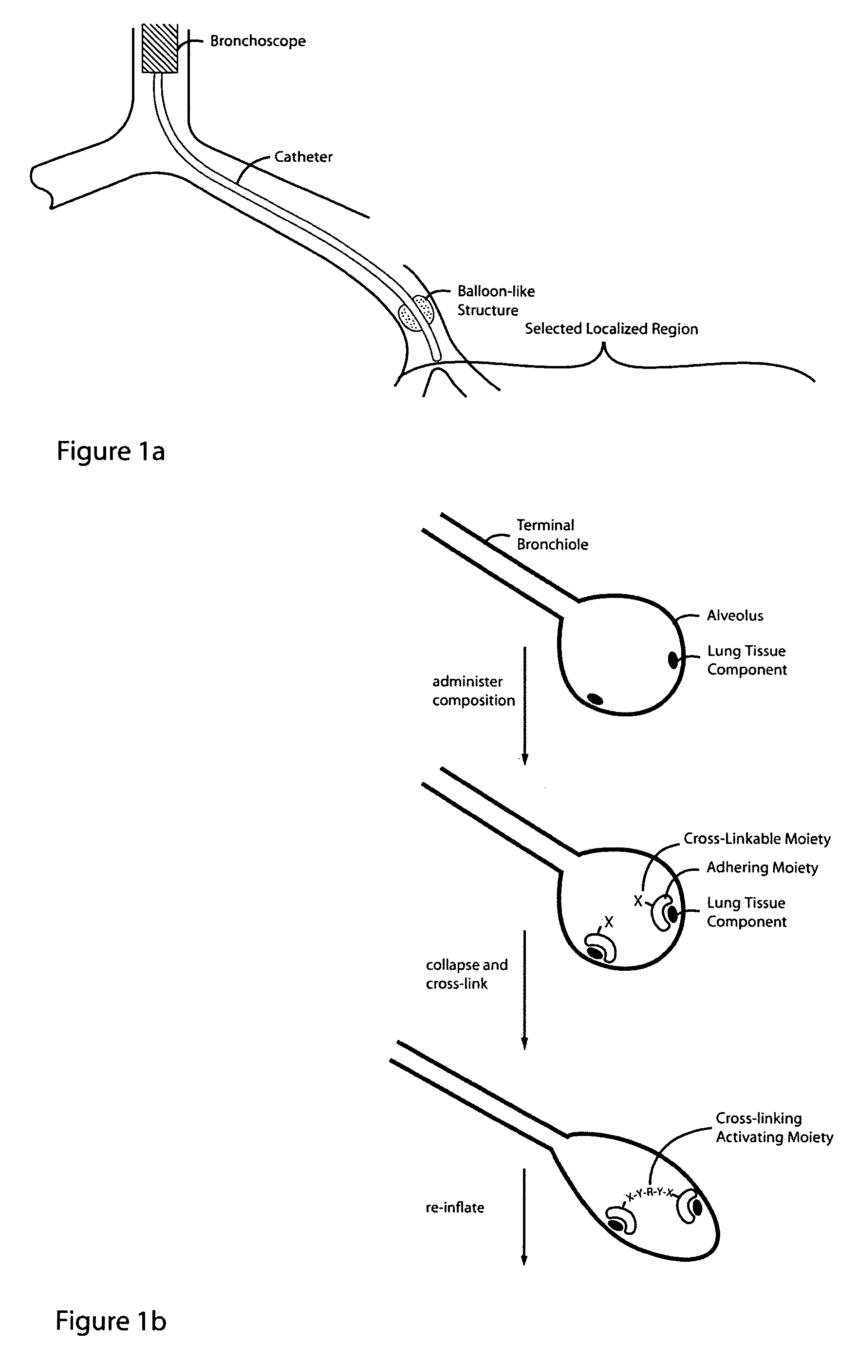 Glue composition for lung volume reduction