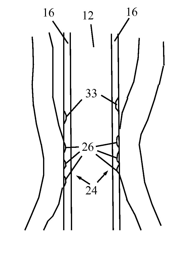 Nasogastric Tube