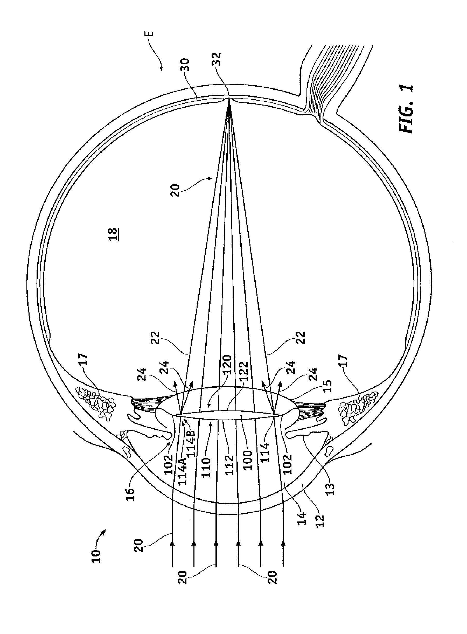 Microincision lens