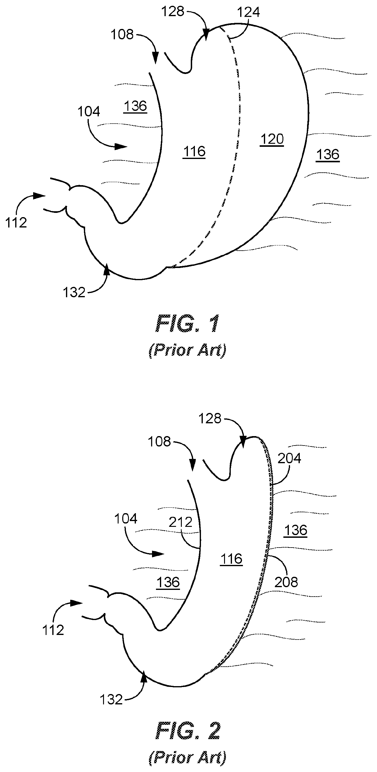 Post gastrectomy anchoring procedure