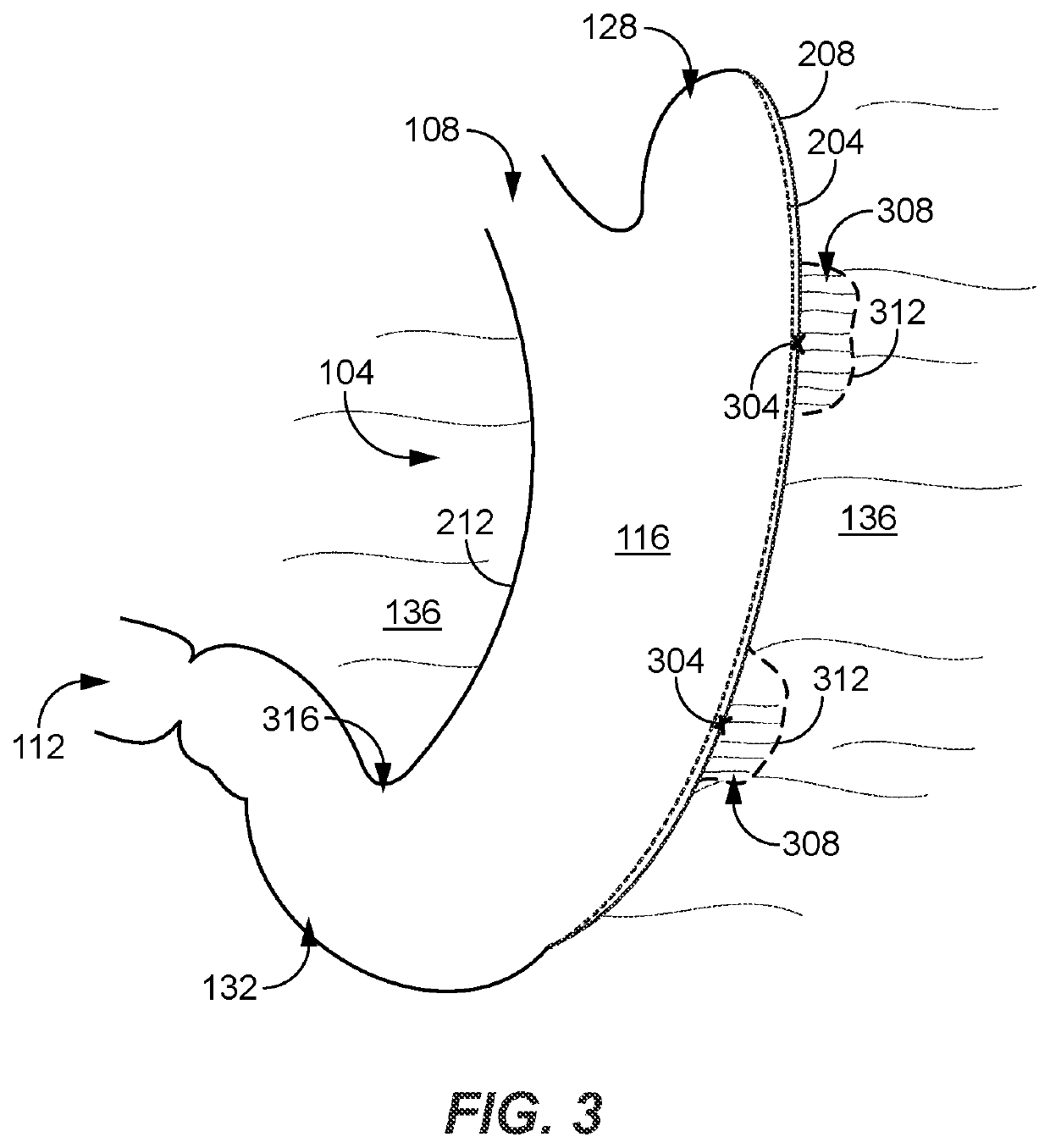 Post gastrectomy anchoring procedure