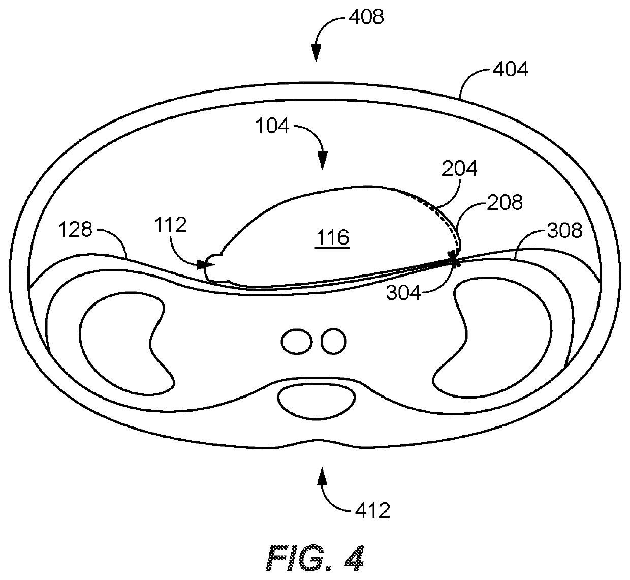 Post gastrectomy anchoring procedure