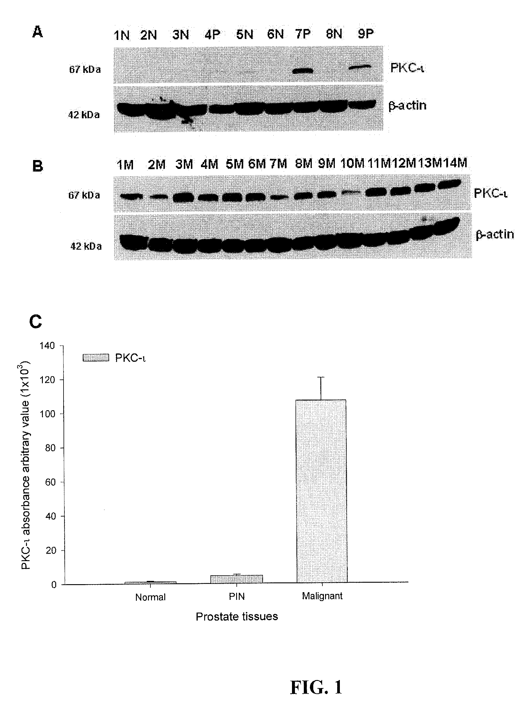 Prostate carcinogenesis predictor