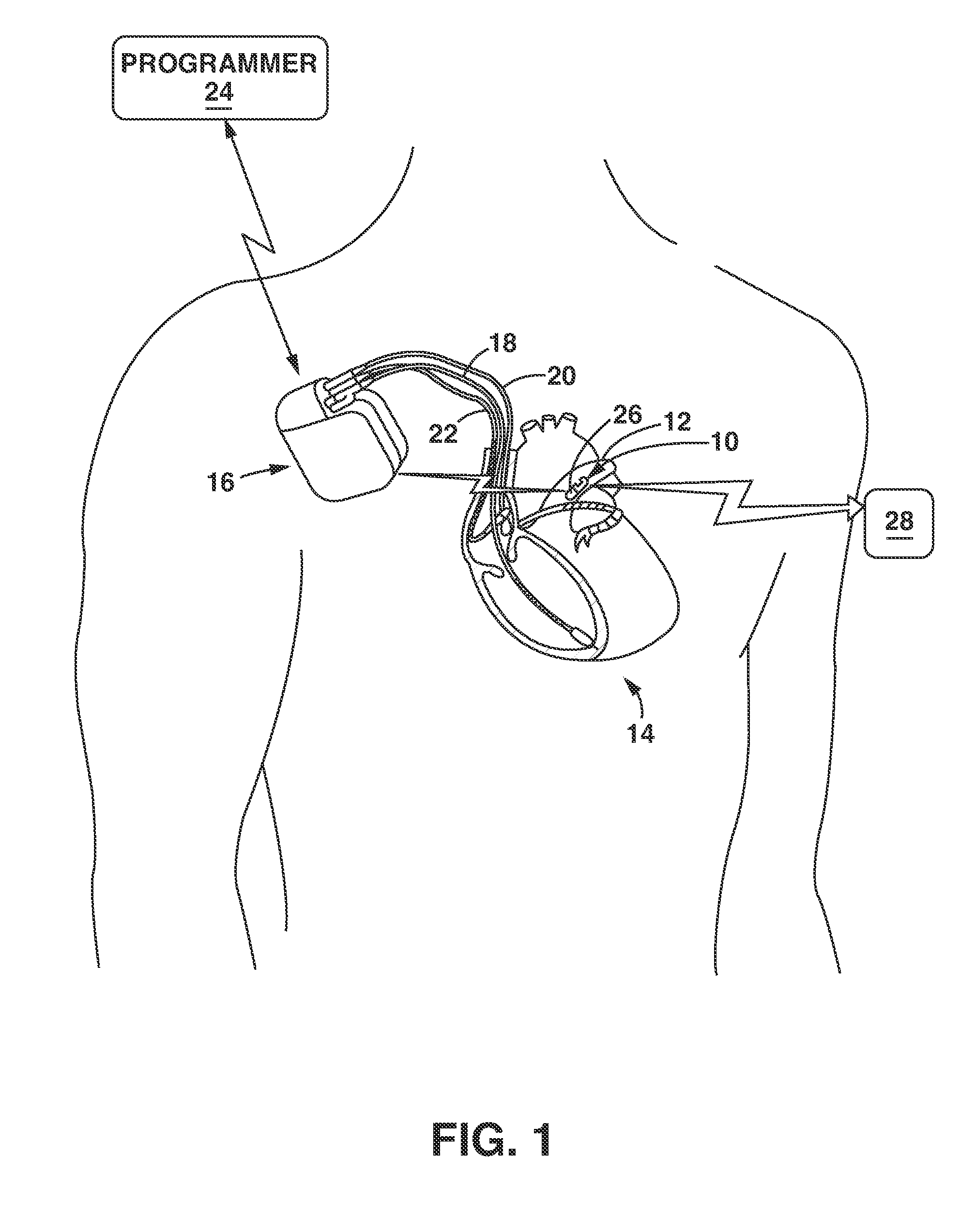 Implantable medical sensor and fixation system