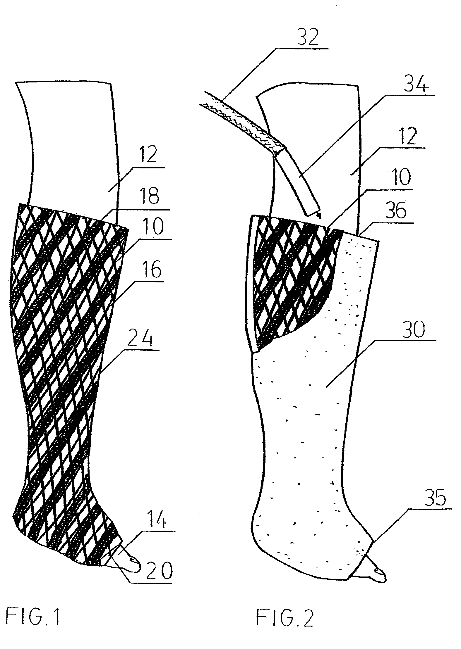 Venting devices for surgical casts and other orthopedic devices