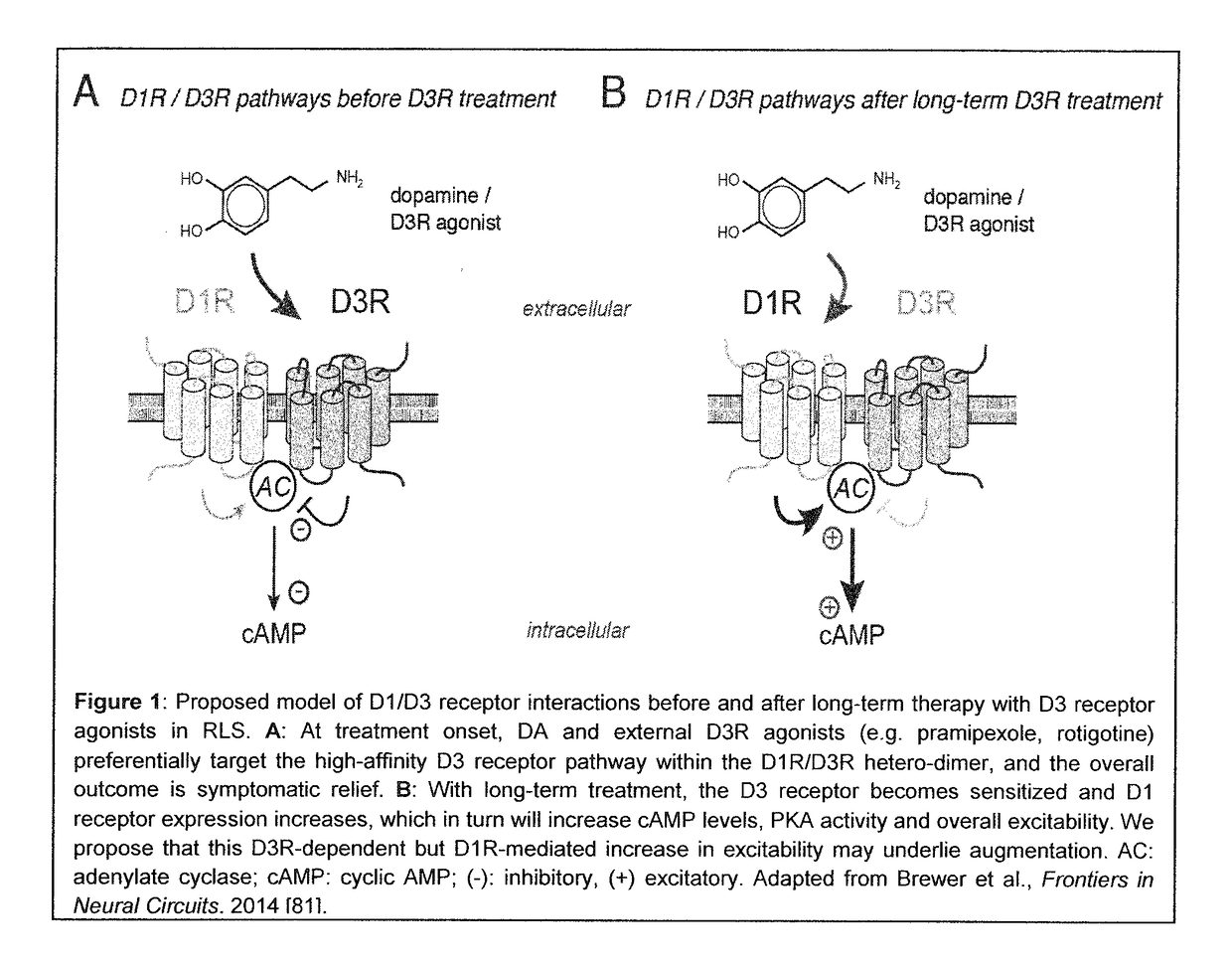 Treatment and management of augmentation in restless legs syndrome