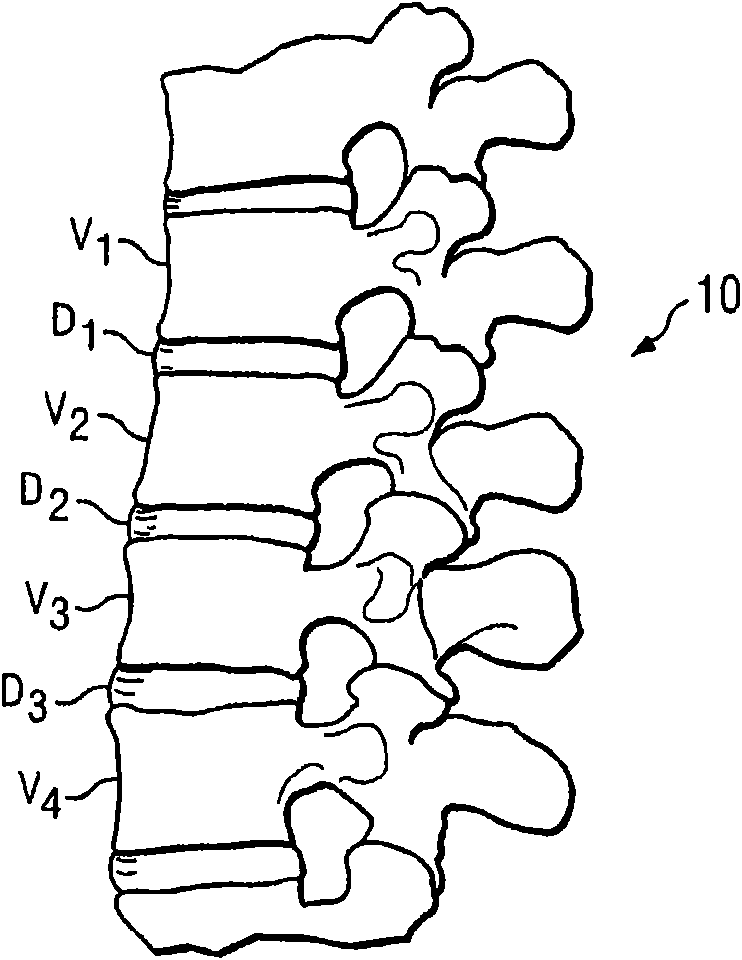 Posterior total joint replacement