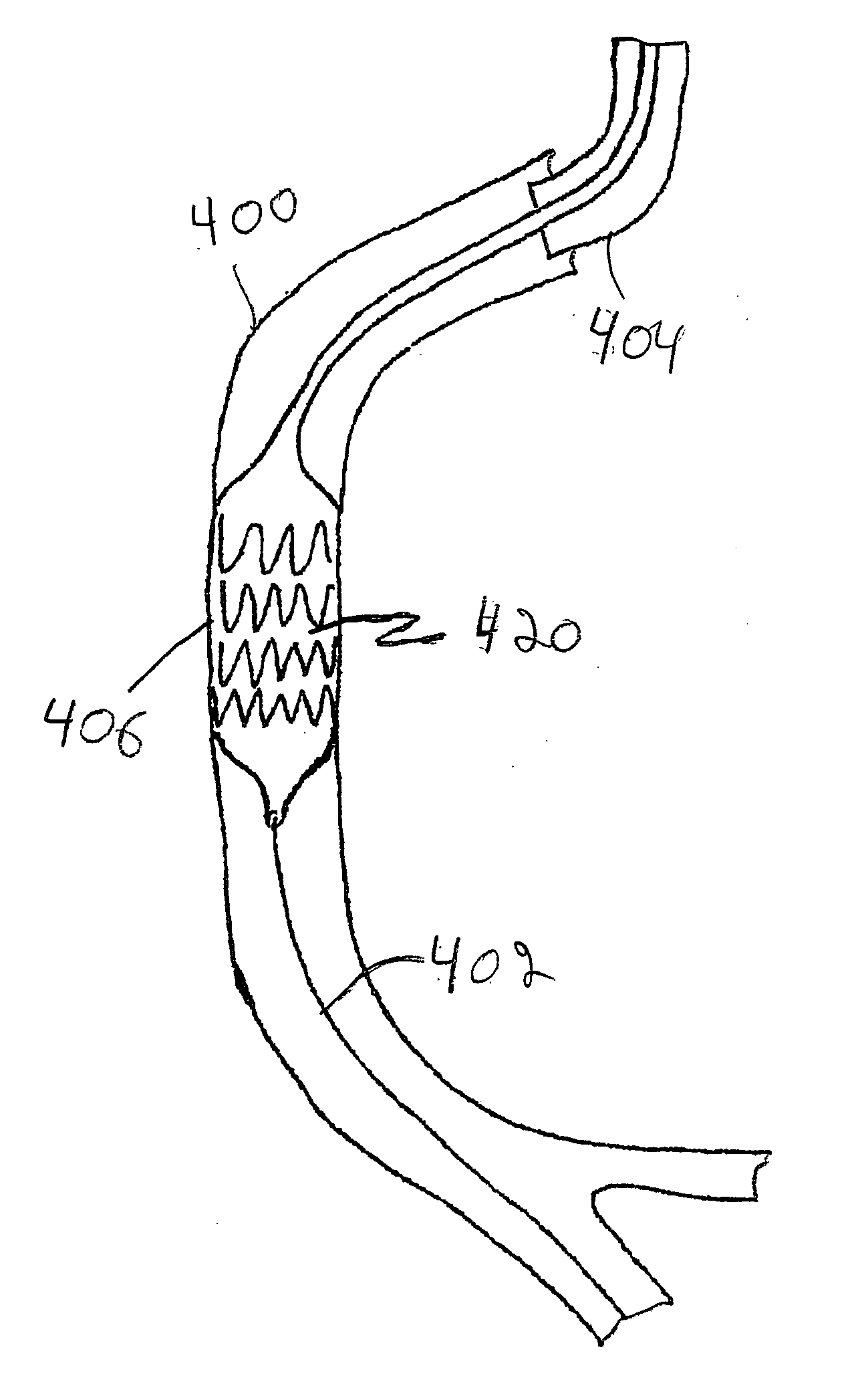 Thrombectomy catheter