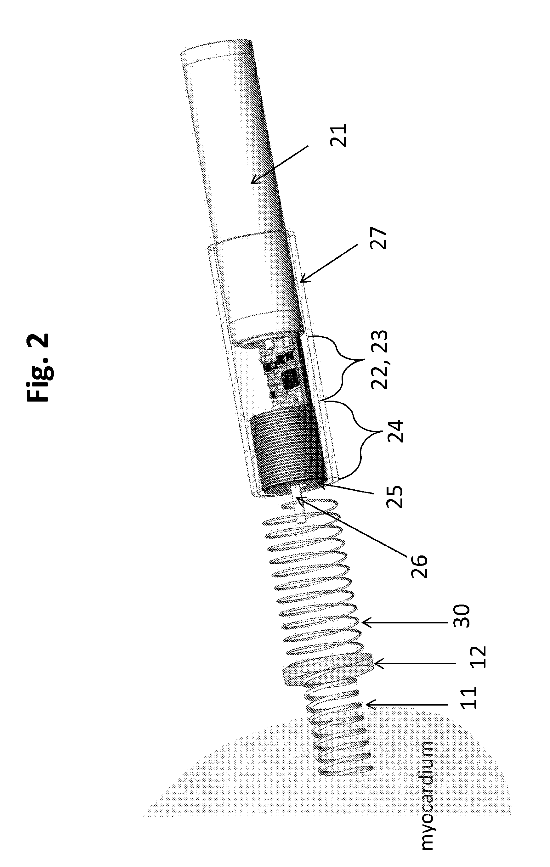 Minimally invasive epicardial pacemaker