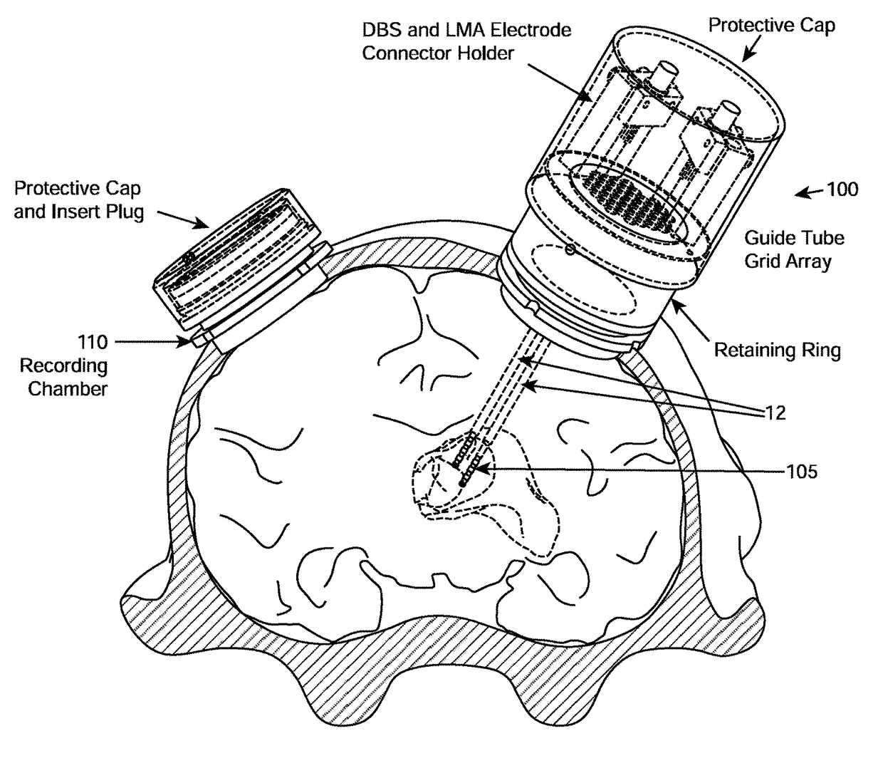 System and methods for multi-site activation of the thalamus