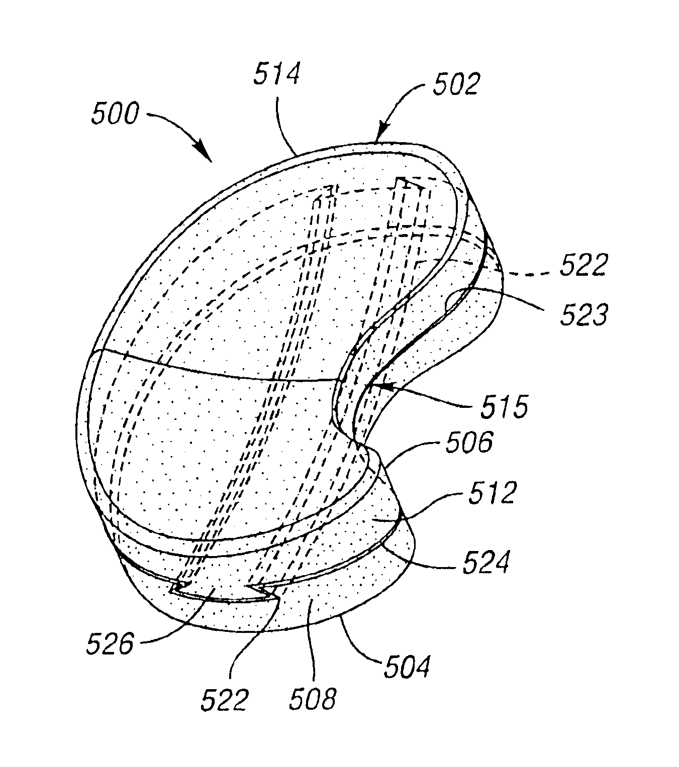 Surgically implantable knee prosthesis having two-piece keyed components